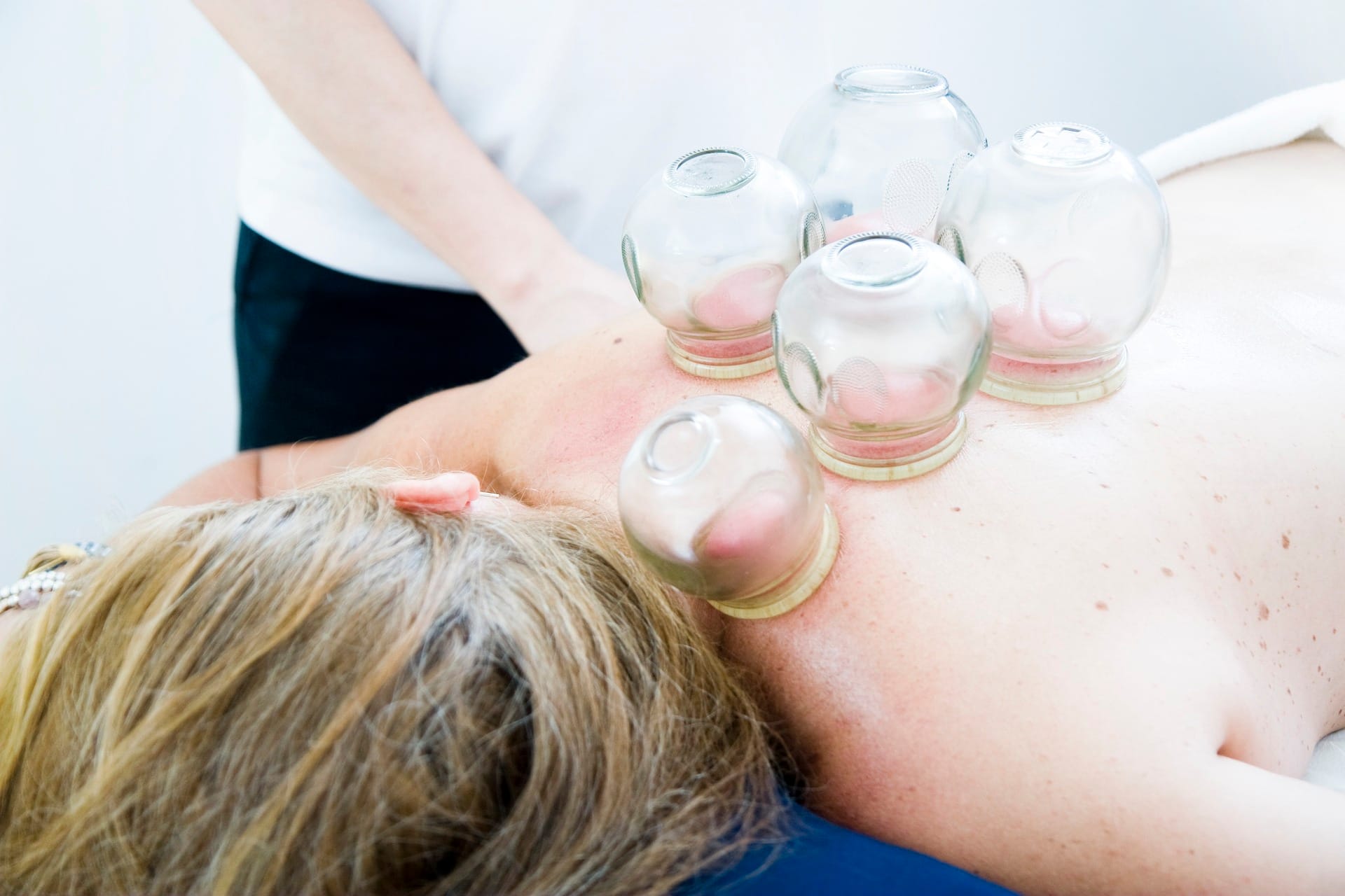 Velkommen til cupping – en ældgammel behandling med moderne effekt
